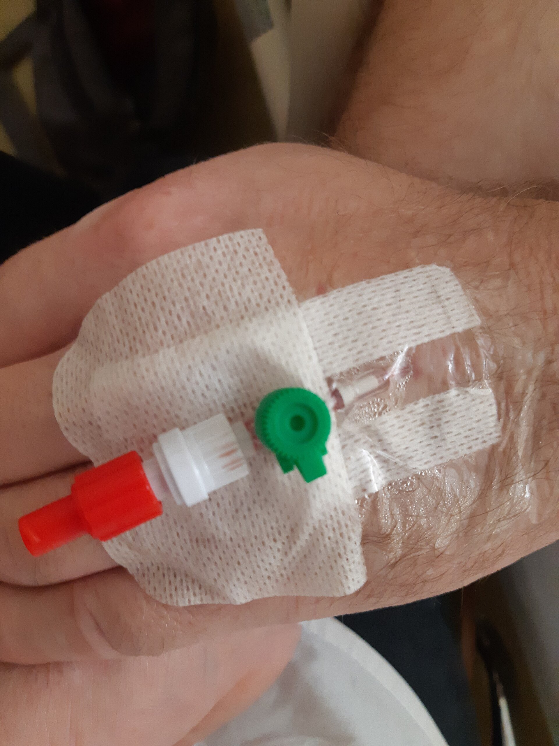 An IV catheter taped to the back of a hand