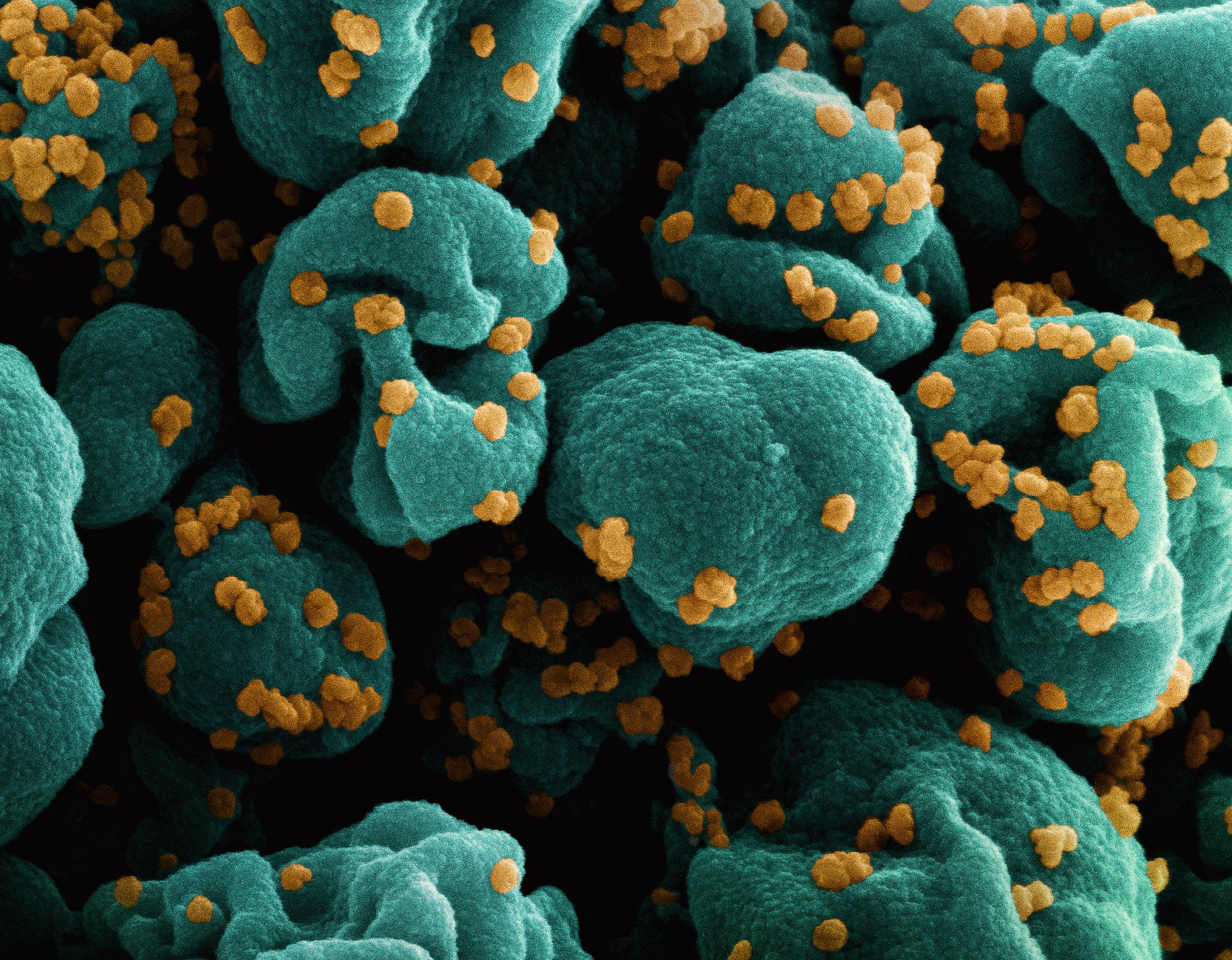 Colourised electron microscope image of a cell covered in orange Covid virus particles