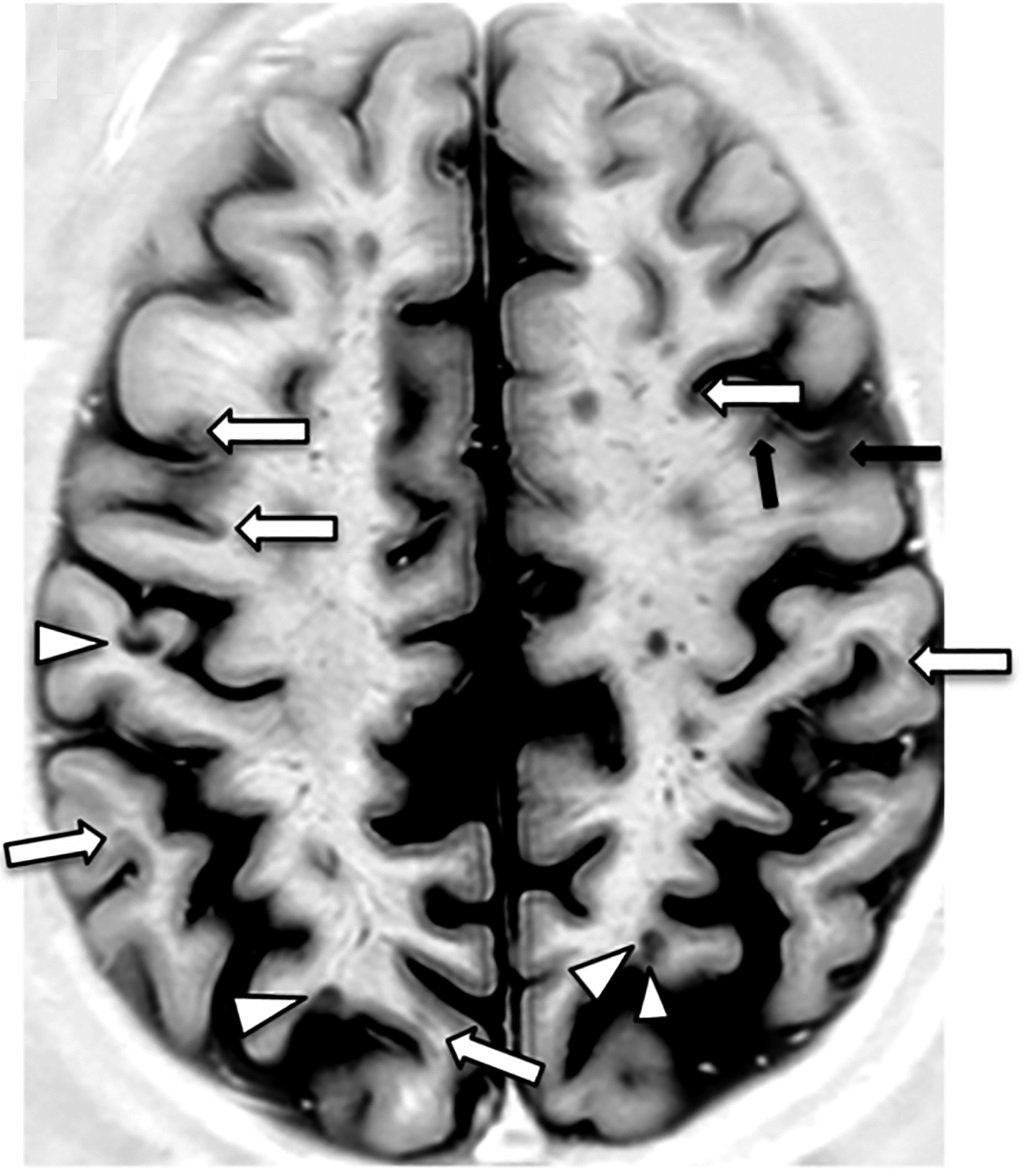 An MRI scan showing lesions from multiple sclerosis in the brain